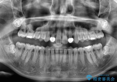 前歯のデコボコと小さい歯を改善　インビザラインとオールセラミッククラウンの治療後