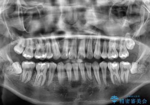 全体的なデコボコをスッキリと　ワイヤー装置での抜歯矯正の治療後
