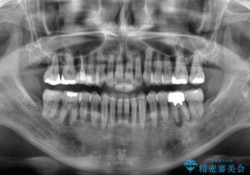 受け口と八重歯を改善　インビザライン矯正治療の治療後