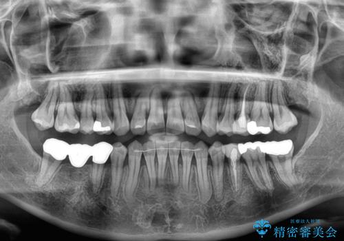 【モニター】前歯のデコボコをインビザラインで綺麗にの治療後