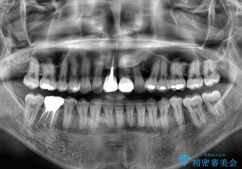 前歯のデコボコをワイヤー矯正で綺麗に　保険診療の前歯クラウンもセラミッククラウンで自然にの治療後
