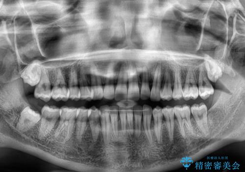 前歯が隠れるほどのデコボコをインビザライン矯正できれいに整えるの治療後