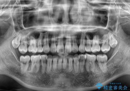 デコボコだらけの歯列をきれいに　ワイヤー装置での抜歯矯正治療の治療後