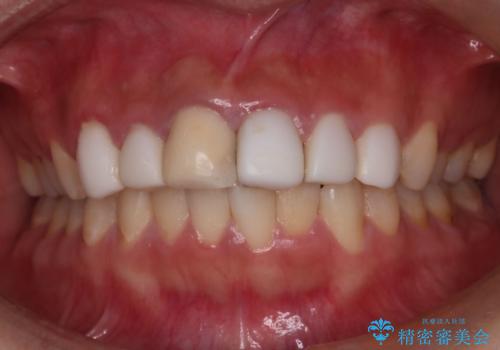 【オールセラミッククラウン】歯の色を合わせたいの治療前