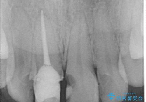【オールセラミッククラウン】歯の色を合わせたいの治療前