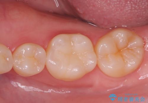 銀歯の段差と虫歯リスクを改善|ラバーダム防湿下で行うセラミックインレー治療の症例 治療後