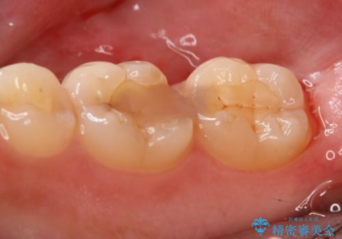 奥歯を良いもので治したい セラミックインレーの治療前