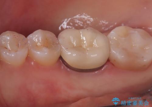 【セラミックインレー】歯の奥側に虫歯ができてしまったの治療後