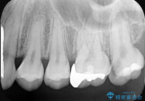 神経を抜かずに守る。MTAを用いた部分的断髄法と精密セラミック修復の治療前