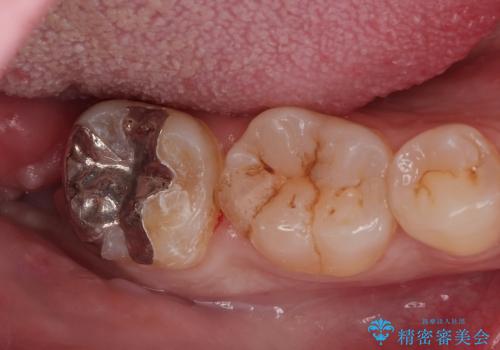 親知らず抜歯後、虫歯治療の症例 治療後