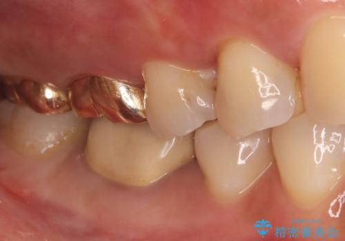 【セラミックインレー】歯の奥側に虫歯ができてしまったの治療前