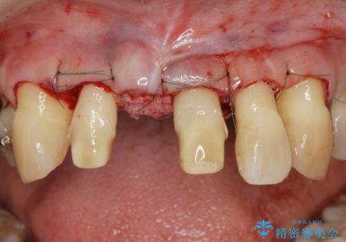 [ 再生療法 ]  歯周病治療を行った前歯のセラミック治療の治療中