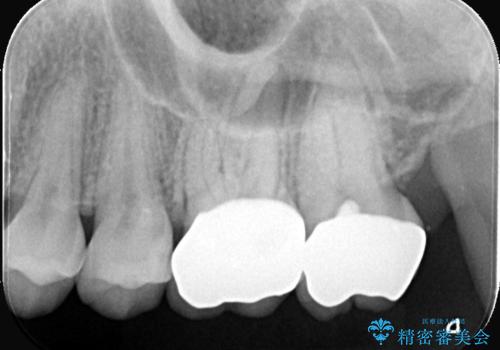 神経を抜かずに守る。MTAを用いた部分的断髄法と精密セラミック修復の治療後
