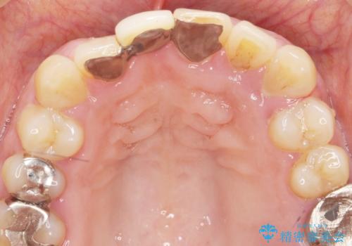 [ 再生療法 ]  歯周病治療を行った前歯のセラミック治療の治療前