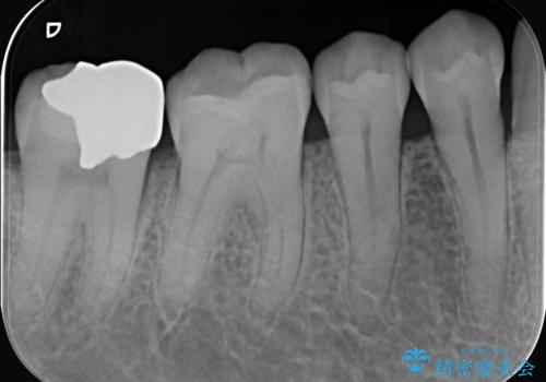 全ての銀歯をセラミックへ。お口全体をメタルフリーにして笑顔まで明るくの治療前