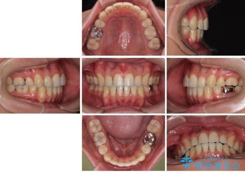 口が閉じにくい原因を根本から改善|上下顎4本抜歯による矯正治療症例の治療後