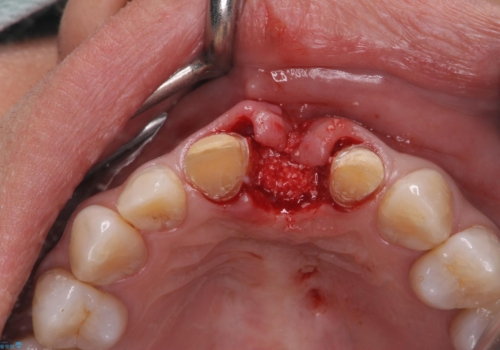 [ 欠損部の著しい骨欠損 ]　歯ぐきのボリュームを回復し自然なブリッジ作製治療の治療中
