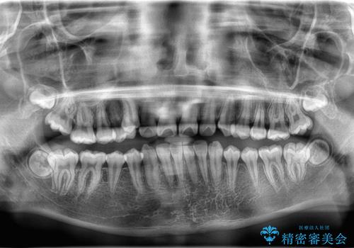 八重歯・歯並びのデコボコとディープバイトを改善した抜歯ワイヤー矯正症例の治療前