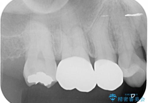 銀歯をやり変えたい　セラミックインレーの治療前