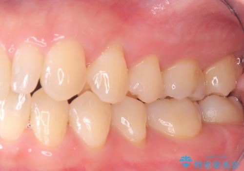 銀歯の段差と虫歯リスクを改善|ラバーダム防湿下で行うセラミックインレー治療の治療後