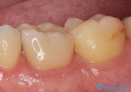 [ セラミック治療 ]  清掃性の悪い修復物を改善の症例 治療後