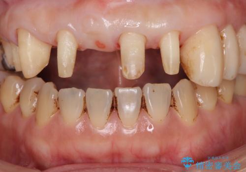 [ 再生療法 ]  歯周病治療を行った前歯のセラミック治療の治療中