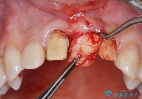 [ 欠損部の著しい骨欠損 ]　歯ぐきのボリュームを回復し自然なブリッジ作製治療の治療中