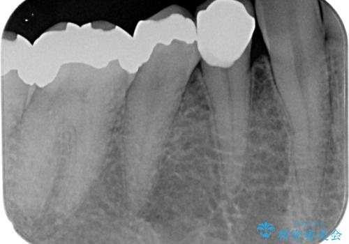 金属の詰め物が取れた オールセラミッククラウンの治療後