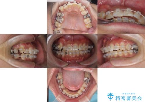 【ワイヤー矯正】八重歯と下の歯の凸凹を治したいの治療中