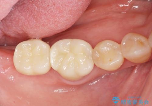 咬合機能を回復する奥歯のインプラント治療の治療後
