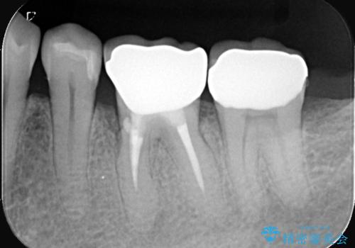 全ての銀歯をセラミックへ。お口全体をメタルフリーにして笑顔まで明るくの治療後