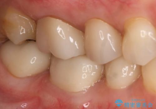銀歯をやり変えたい　セラミックインレーの治療前