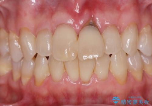 [ 欠損部の著しい骨欠損 ]　歯ぐきのボリュームを回復し自然なブリッジ作製治療の治療前