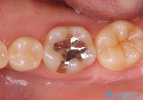 銀歯の段差と虫歯リスクを改善|ラバーダム防湿下で行うセラミックインレー治療の症例 治療前