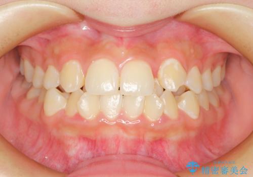 重度のガタガタを効率よく改善。ワイヤー矯正とインビザラインの併用治療の症例 治療前