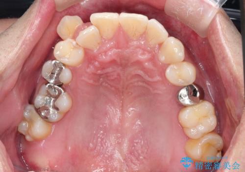 【ワイヤー矯正】八重歯と下の歯の凸凹を治したいの治療前