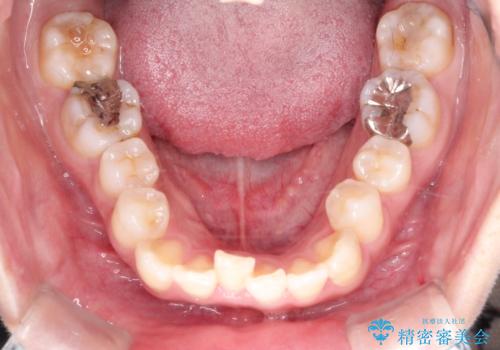 【ワイヤー矯正】口元を下げたい、下の歯の凹凸を無くしたいの治療前