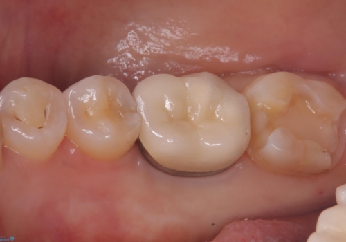 【セラミックインレー】歯の奥側に虫歯ができてしまったの治療中