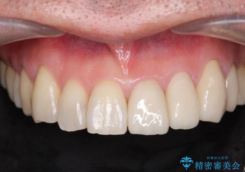 前歯の歯間に発生した虫歯のセラミック治療の症例 治療後