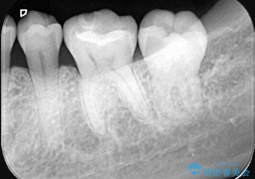 銀歯の段差と虫歯リスクを改善|ラバーダム防湿下で行うセラミックインレー治療の治療後