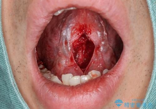 【舌小帯切除】ら行が言いづらいの治療中