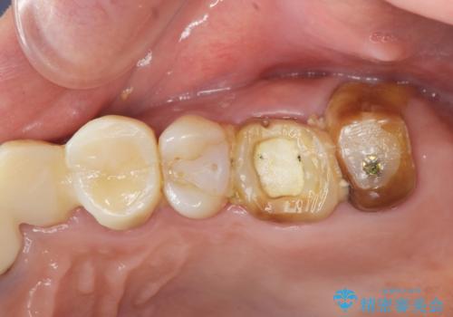 歯ブラシのしやすいクラウンへのやりかえの治療前