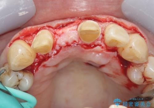 [ 再生療法 ]  歯周病治療を行った前歯のセラミック治療の治療中
