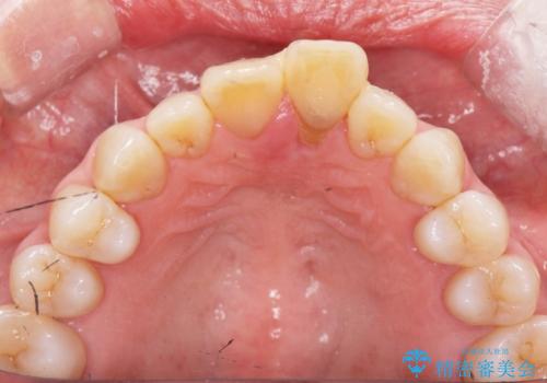 [ 欠損部の著しい骨欠損 ]　歯ぐきのボリュームを回復し自然なブリッジ作製治療の治療前