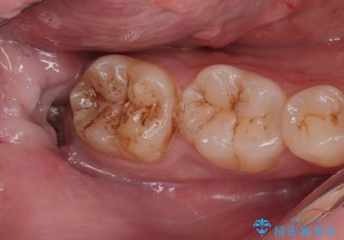 親知らず抜歯後、虫歯治療の治療前