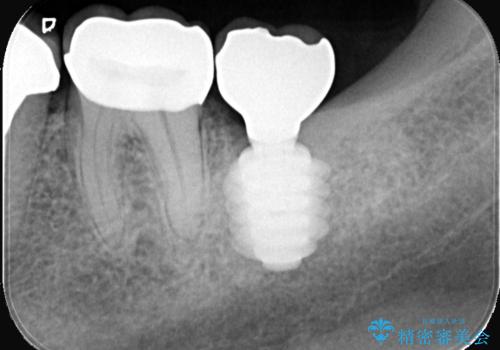 歯根嚢胞と瘻孔を伴う奥歯を抜歯即時インプラントで治療|一回の手術で改善!|インプラントの治療期間3か月の治療後