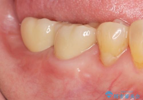 咬合機能を回復する奥歯のインプラント治療の症例 治療後