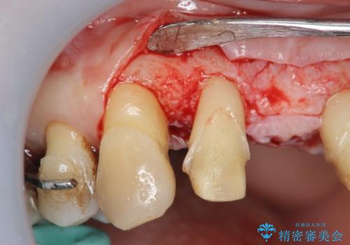 [ 再生療法 ]  歯周病治療を行った前歯のセラミック治療の治療中