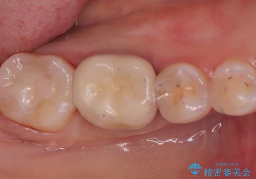 【セラミックインレー】歯の奥側に虫歯ができてしまったの治療後