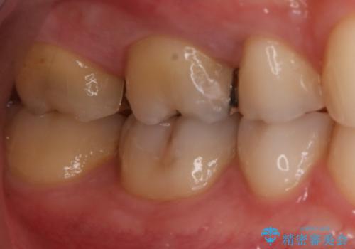 銀歯を金歯にしたい ゴールドインレーの治療前